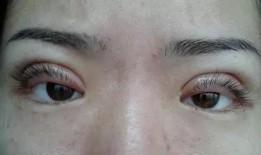 郑州双眼皮爆料案件最新,揭开整形行业潜规则真相